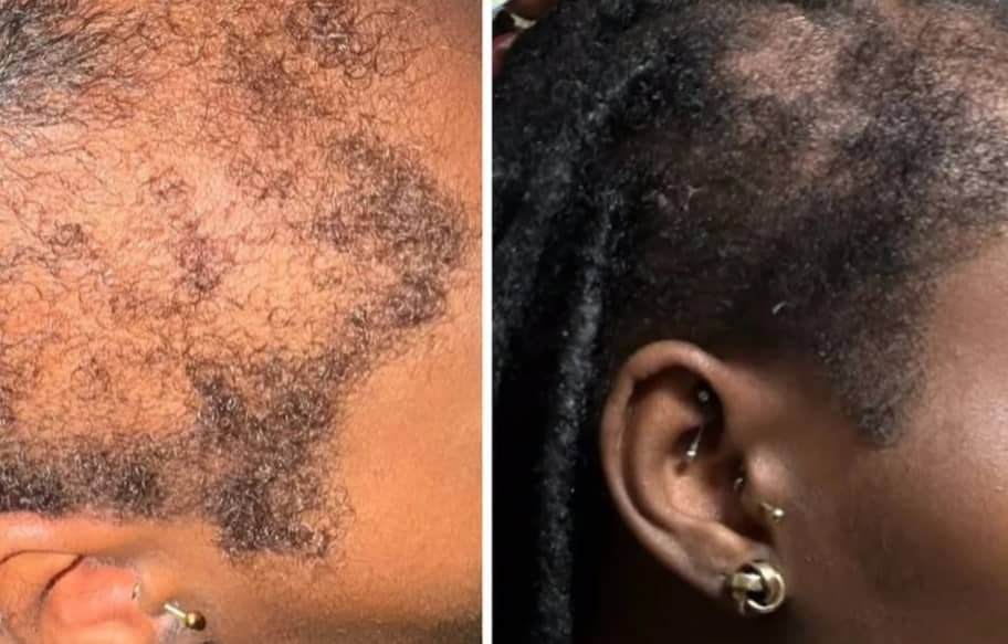 Dar Nour: Hairneedling