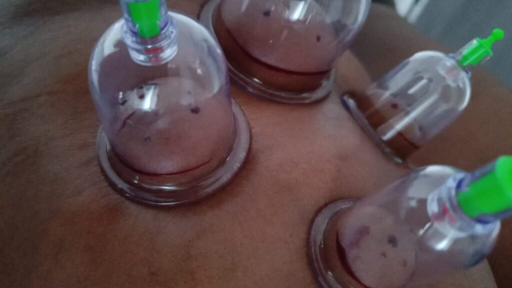 Dar Nour: Cupping Therapy